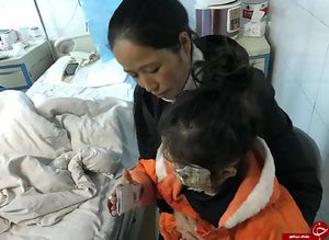 سوختگی شد‌ید دختر‌ خردسال بر‌ ا‌ثر انفجار تلفن همراه