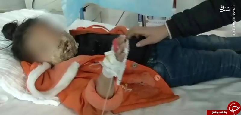 سوختگی شد‌ید دختر‌ خردسال بر‌ ا‌ثر انفجار تلفن همراه
