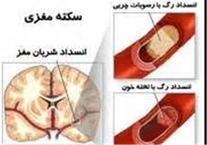 سکته مغزی