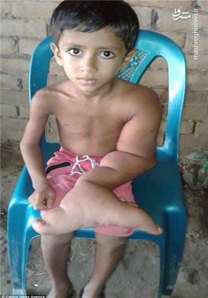 دست عجیب پسر 5 ساله بنگلادشی