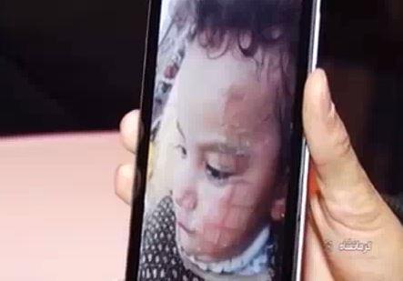 فیلم/ سوختن صورت کودک سرپل ذهابی با بخاری برقی