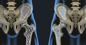 بیماری‌ای که صدای استخوانتان را درمی‌آورد +روش درمان