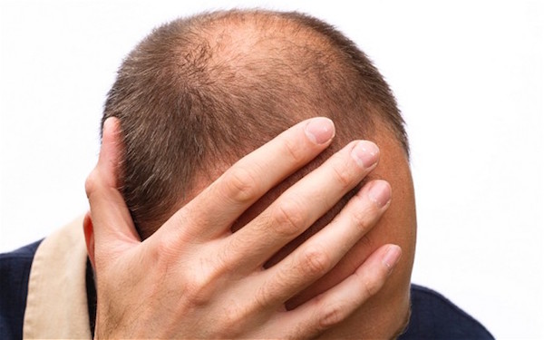 همه چیز درباره ریزش موی آقایان