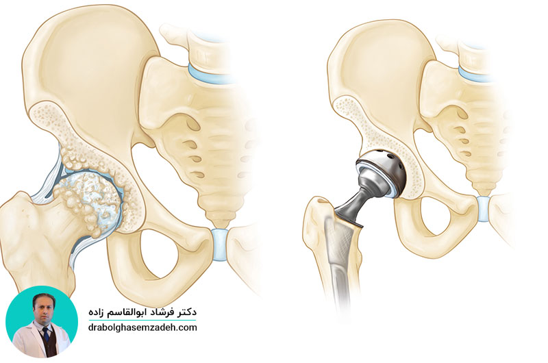 بهترین جراح تعویض مفصل لگن