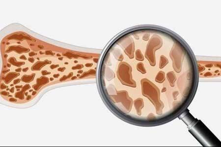 اینفوگرافیک/ علائم پوکی استخوان