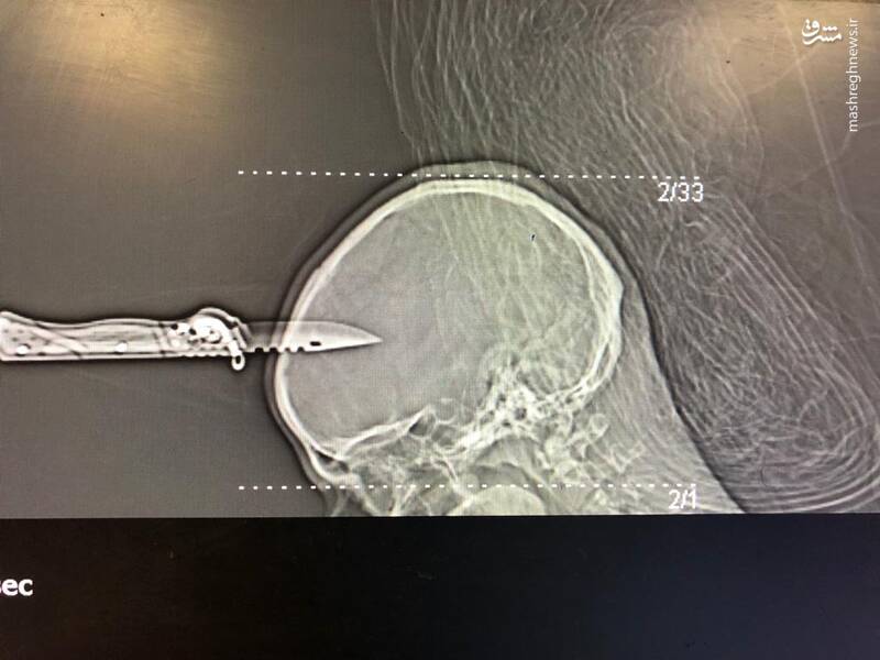 عکس شوک آور از چاقو در جمجمه جوان ورامینی