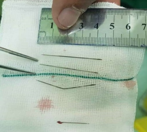 چهار سوزن خیاطی از قلب و قفسه سینه یک زن در اردبیل خارج شد +عکس