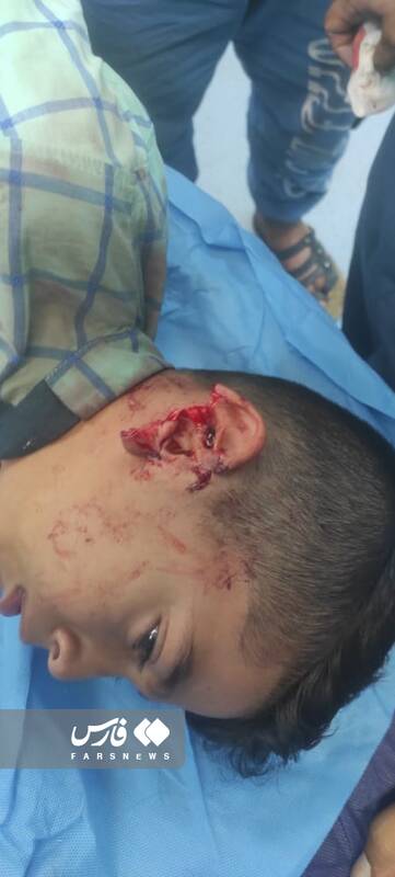 ماجرای حمله سگهای ولگرد به کودک پنج ساله/ گوشتِ گوش پسرم پیوند داده نشد/فاصله دندان سگ با رگ گردن حامد فقط یک سانتیمتر بود