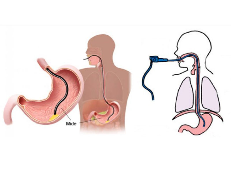 آیا بوتاکس معده در لاغری تاثیر دارد؟