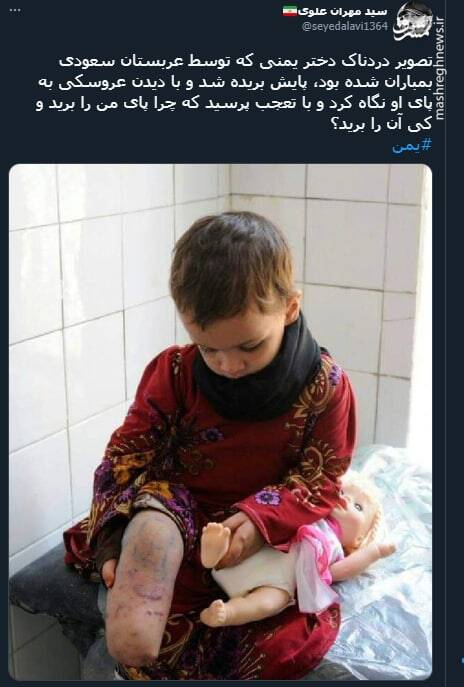 تصویر دردناک دختر یمنی که توسط عربستان سعودی بمباران شده بود