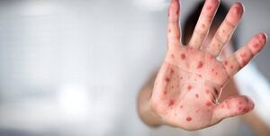 ارسال کیتهای ایرانی تشخیص آبله میمون به دانشگاههای کشور