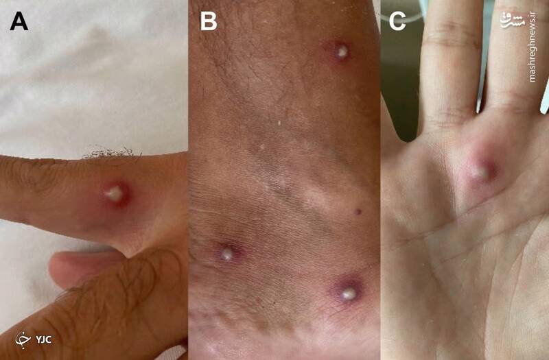 مردی ایتالیایی همزمان به کرونا، آبله میمون و ایدز مبتلا شد