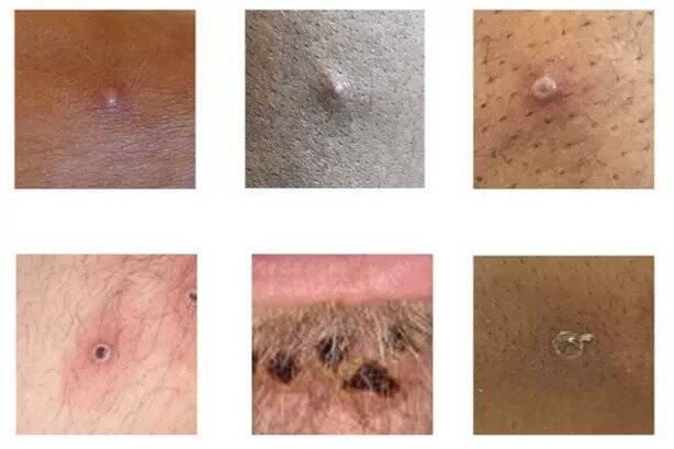 چطور دانههای پوستی آبله میمونی را تشخیص دهیم؟