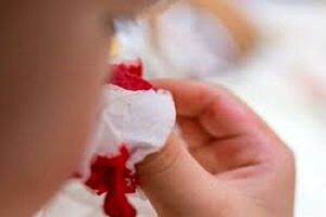 روش‌هایی برای قطع خونریزی بینی