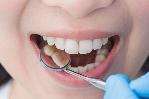 روشهای از بین بردن حساسیت دندانها