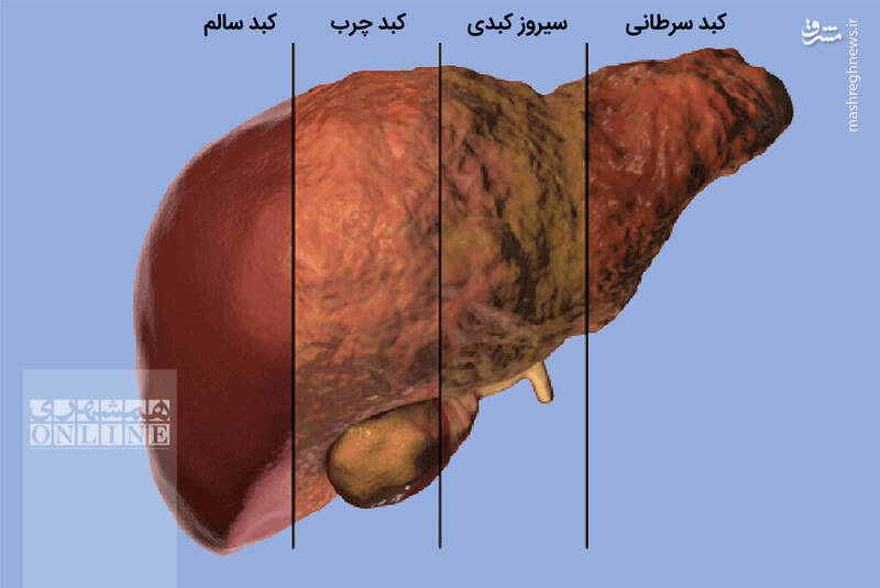 علائم کبد چرب که از آنها بیخبرید