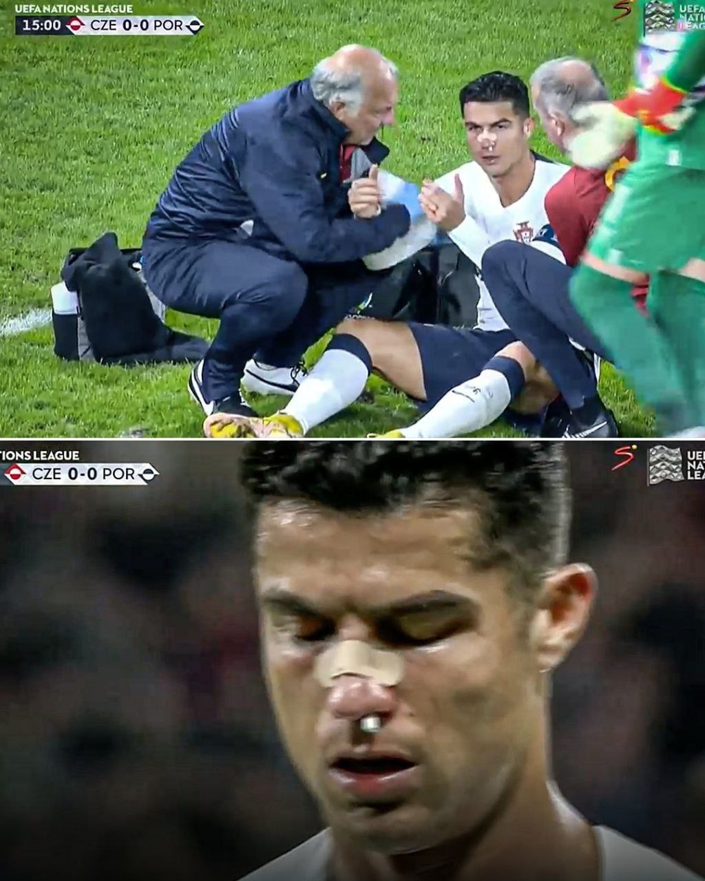 مصدومیت رونالدو از ناحیه بینی +عکس