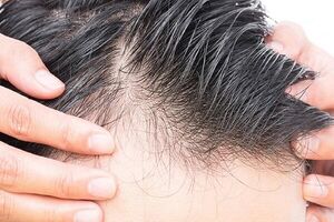 چگونه با استفاده از ویتامینها ریزش مو را کنترل کنیم؟