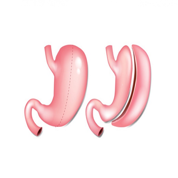 انواع عمل لاغری معده + مزایا و معایب