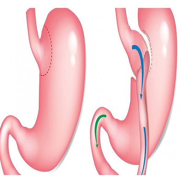 انواع عمل لاغری معده + مزایا و معایب