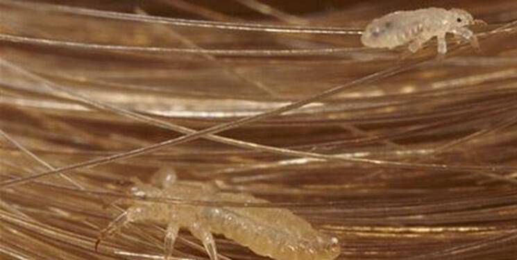 چند روش خانگی برای درمان شپش