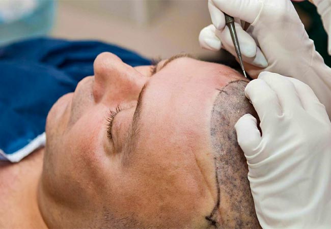 5 علت اصلی کاشت مو ناموفق طبق نظر متخصص پوست و مو