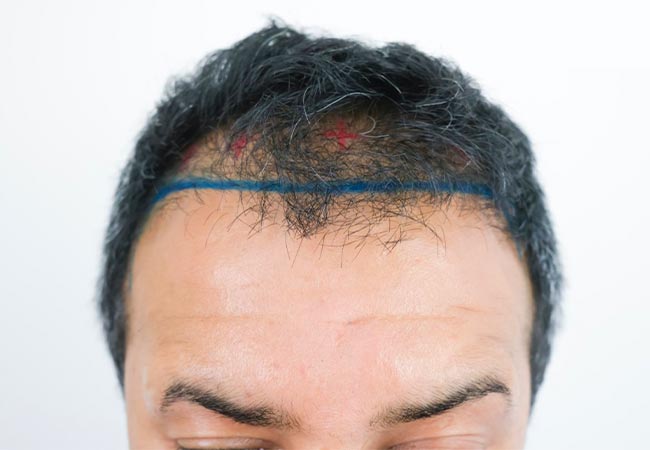 5 علت اصلی کاشت مو ناموفق طبق نظر متخصص پوست و مو