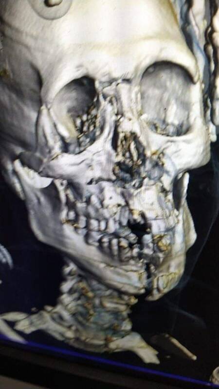 تصاویری وحشتناک از وضعیت بازیکن عربستان/ عکسی از جمجمه خرد شده شهرانی/ بن سلمان جت شخصی فرستاد