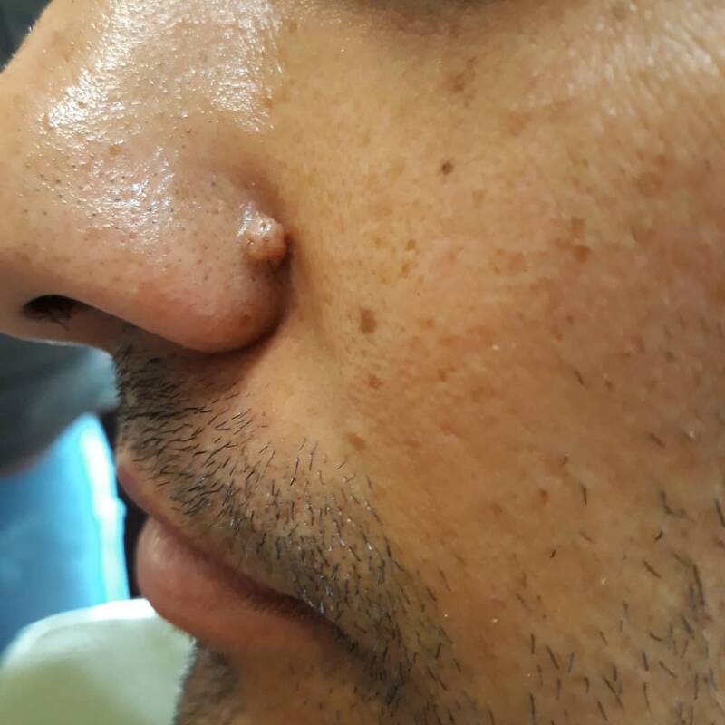 کدام نوع «خالها» خطرناک هستند؟