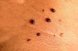 کدام نوع «خالها» خطرناک هستند؟