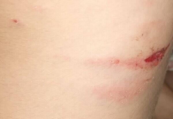 سریال تلخ و تکراری حمله سگهای ولگرد این بار به کودک ۱۰ در انزلی