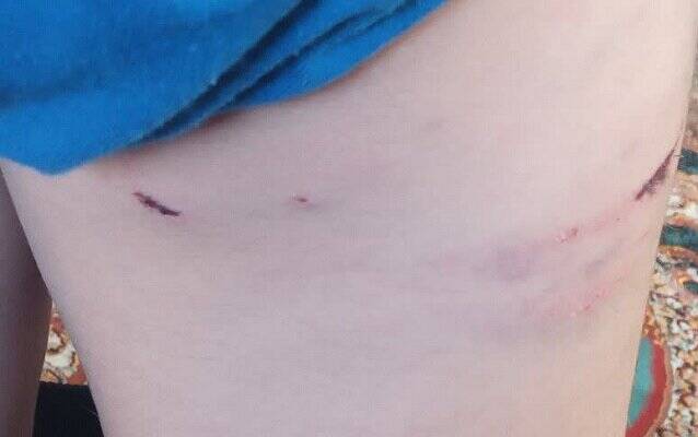 سریال تلخ و تکراری حمله سگهای ولگرد این بار به کودک ۱۰ در انزلی