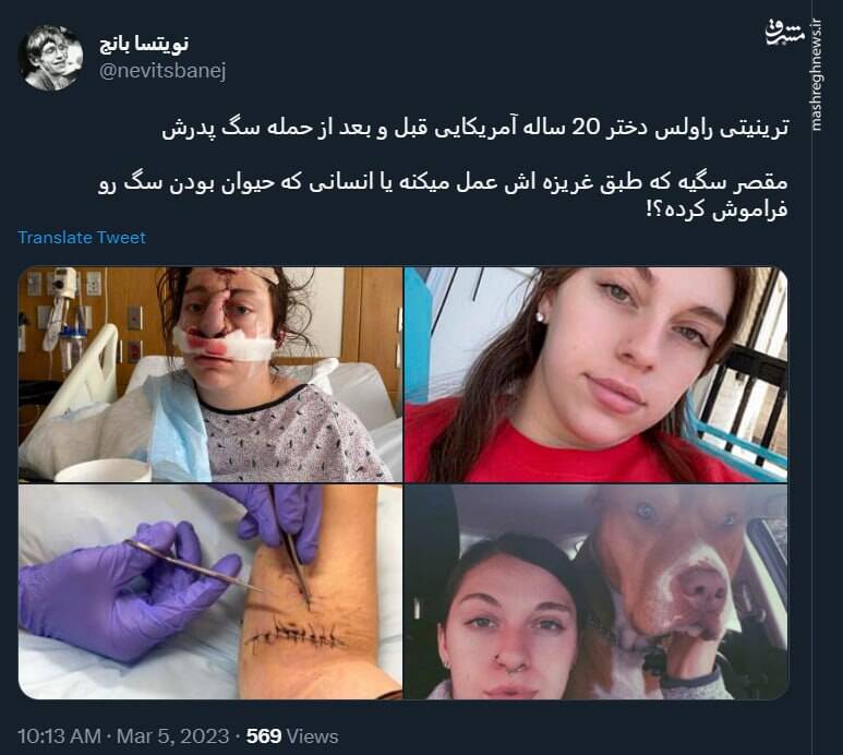 قبل و بعد از حمله سگ به یک دختر ۲۰ ساله+ عکس