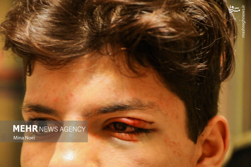 عکس/ مصدومین آخرین چهارشنبه سال ۱۴۰۱ در تبریز (۱۸+)