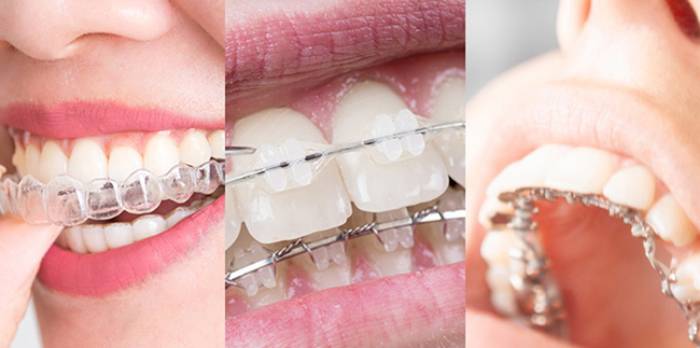 با انواع ارتودنسی نامرئی آشنا شوید