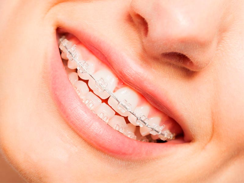 با انواع ارتودنسی نامرئی آشنا شوید