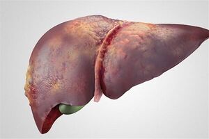 بهترین راه درمان کبد چرب چیست؟ چه افرادی در معرض خطر ابتلا به کبد چرب قرار دارند؟