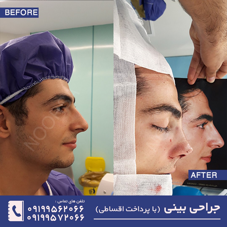 داروهای بعد از جراحی بینی چیست و چگونه باید مصرف کرد؟