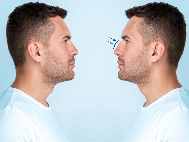 داروهای بعد از جراحی بینی چیست و چگونه باید مصرف کرد؟