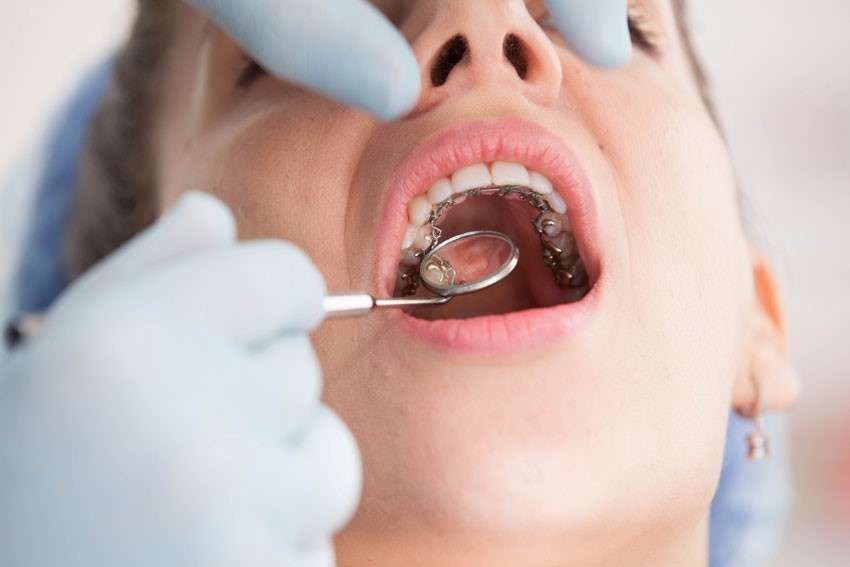 همه چیز درباره ارتودنسی دندان