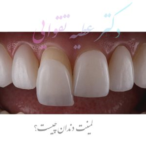 لمینت دندان یا ونیر کامپوزیت دندان؟ بهترین روش زیبایی دندان کدام است؟