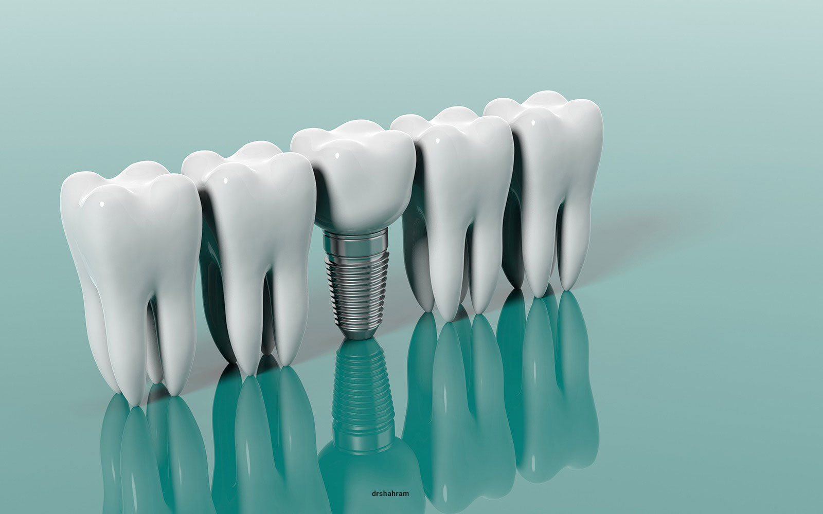 ایمپلنت دندان چه مزایایی دارد و قیمت آن چطور تعیین می شود؟