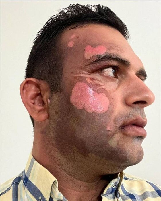 شکارچی صورت محیطبان بهشهری را سوزاند +عکس