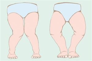 علتهای پرانتزی شدن پاها چیست؟ علتهای پرانتزی شدن پاها چیست؟