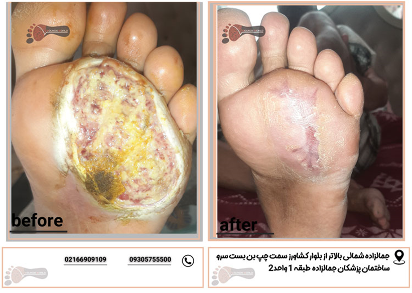 0 تا 100 خدمات کلینیک زخم (درمان انواع زخم)