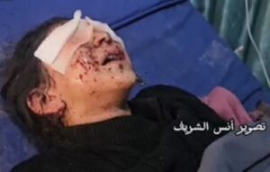 تصویری از کودک زخمی فلسطینی در حملات صبح امروز صهیونیست ها به خانیونس