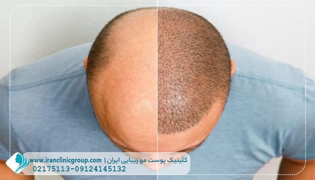 برای کاشت مو کدام روش مورد تأیید می باشد؟