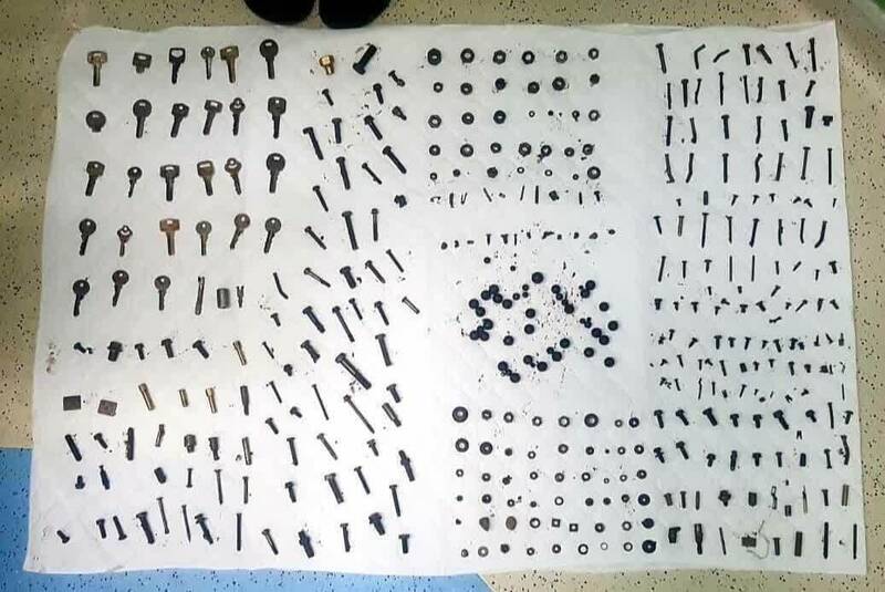 خارج کردن پیچ و مهره از شکم بیمار