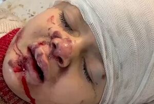مجروحیت شدید یک کودک فلسطینی در خان یونس