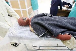 کدام خدمات درمان سوختگی شامل بیمه میشود؟